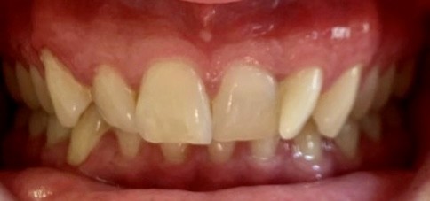 George’s teeth before treatment