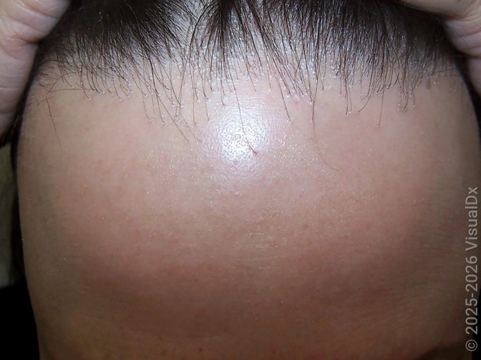 Frontal Fibrosing Alopecia — image from NorCal Hair Doctor™'s existing website