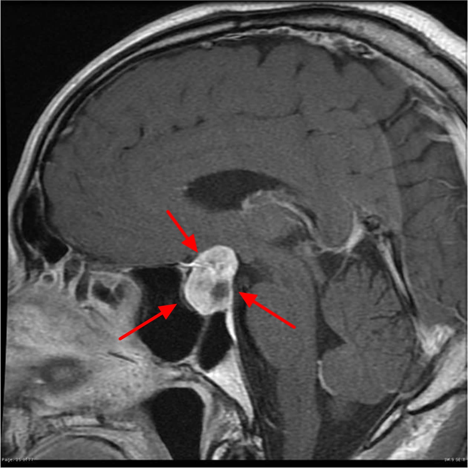 MRI scan of a brain displaying a Pituitary tumor highlighted for diagnosis.