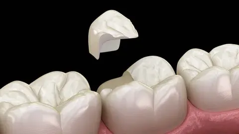 Intraoral Cameras
