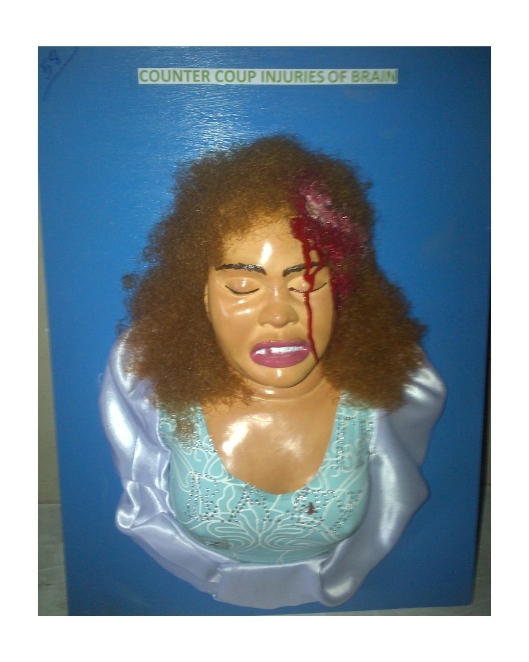 Counter Coup Injuries of Brain