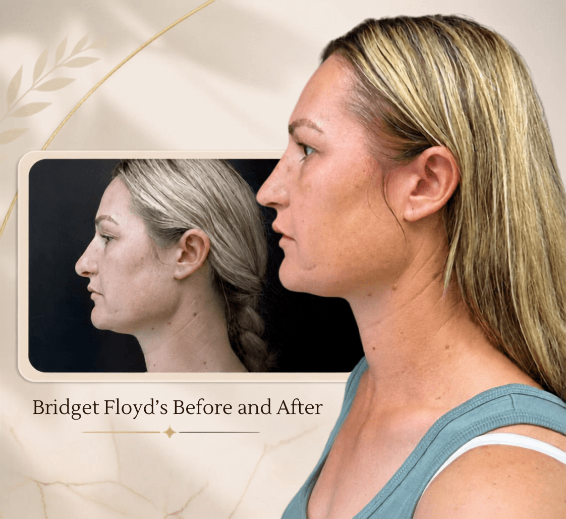 Before and after photos accompanying Bridget's review of the Floyd procedure.