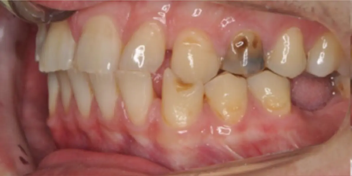 Prima e dopo il trattamento ortodontico funzionale, senza estrazione dei denti premolari