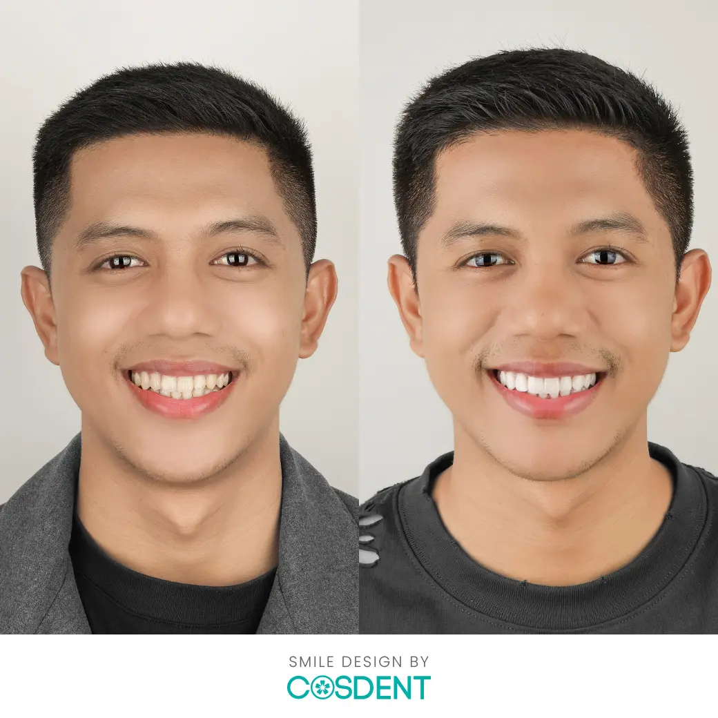 คุณเฟียส befor and after ผลงานออกแบบรอยยิ้มวีเนียร์ cosdent smile design