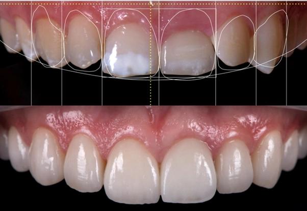 Dental Filling