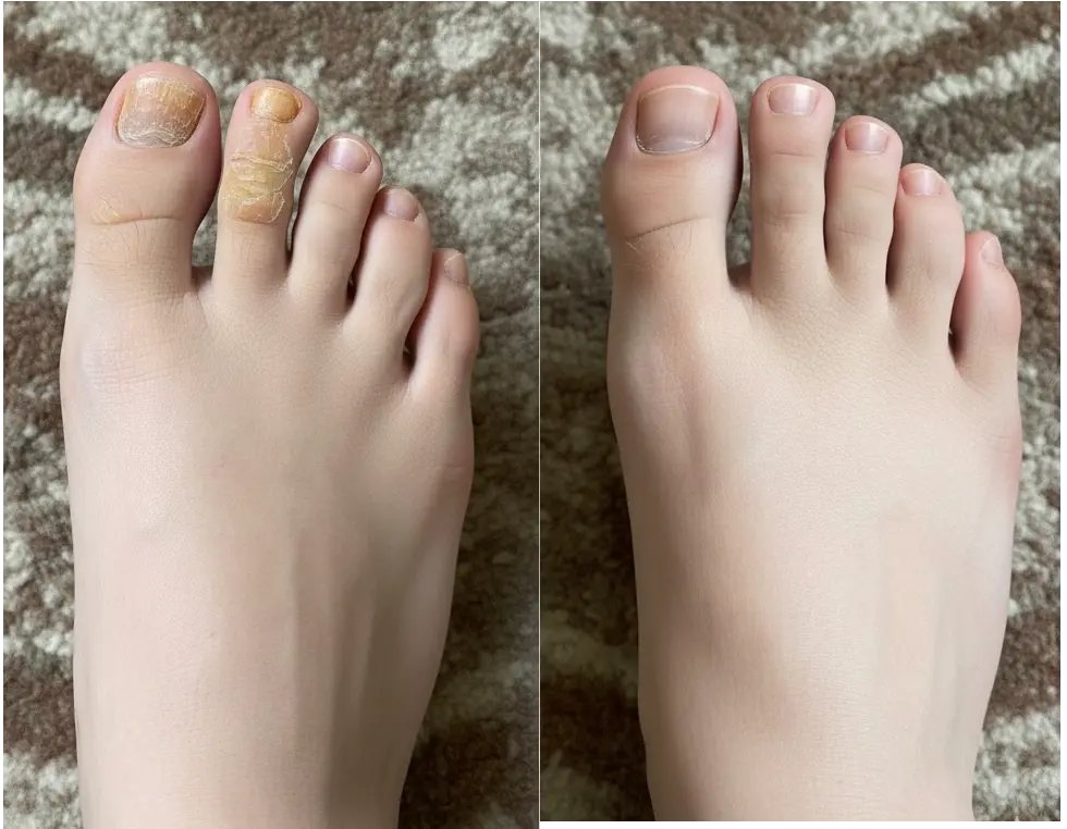 Before and after treatment - hand