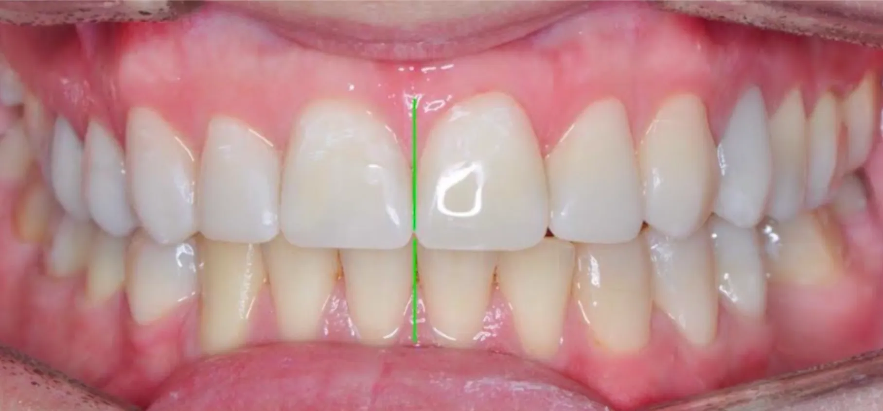 Harmonised occlusion and aesthetic restorations. No surgery