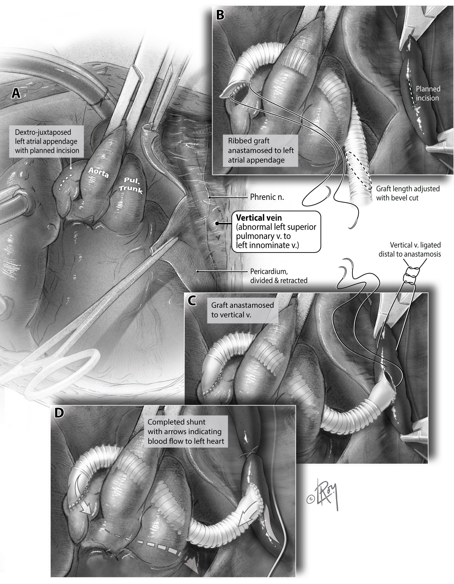 PAPVR Surgical Sequence