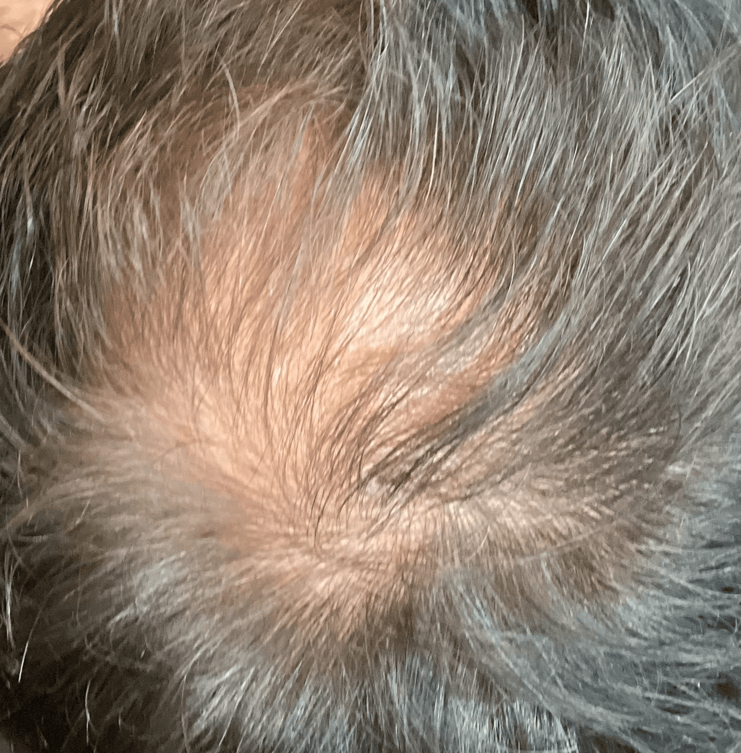 Microscopic close-up of oily scalp buildup on head of client before treatment