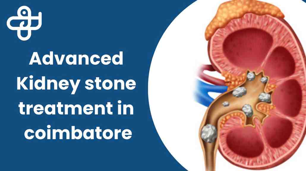 Advanced Kidney Stone
