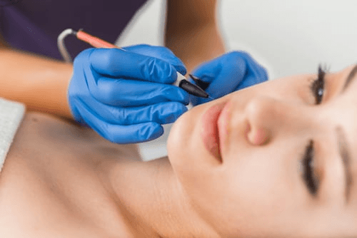 Electrolysis Permanent Hair Removal