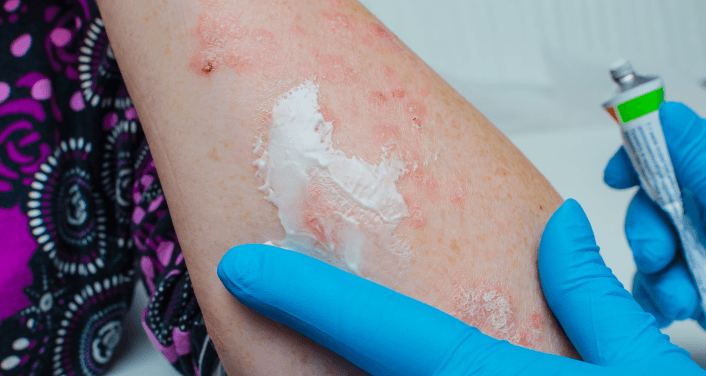 A gloved healthcare professional in blue latex gloves applies white cream from a tube onto a patient's arm, which shows inflamed, flaky skin consistent with a dermatological condition such as eczema or psoriasis.