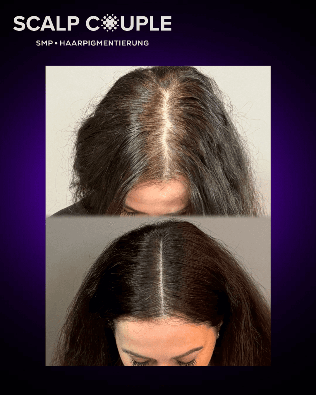 Haarpigmentierung Frau Vorher Nachher – Stufe 1 bei beginnender Ausdünnung | Scalp Couple