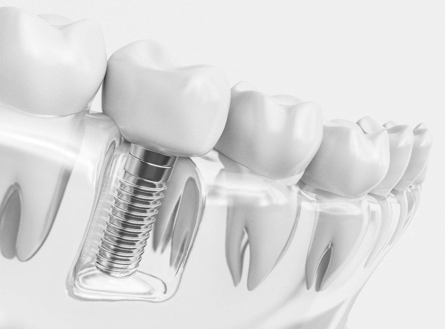 Dental implant in Hong Kong 