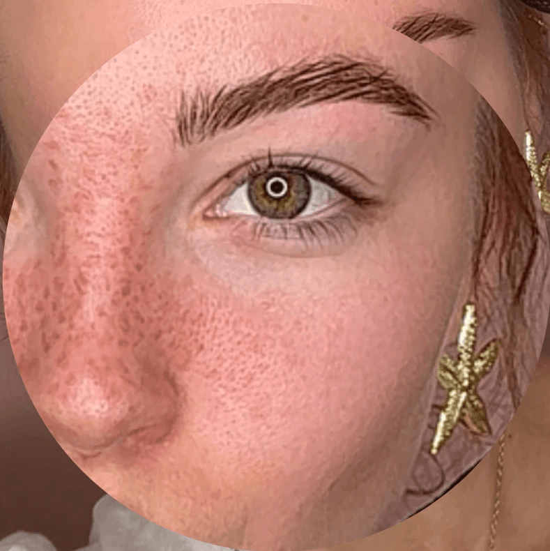 Dermopigmentation