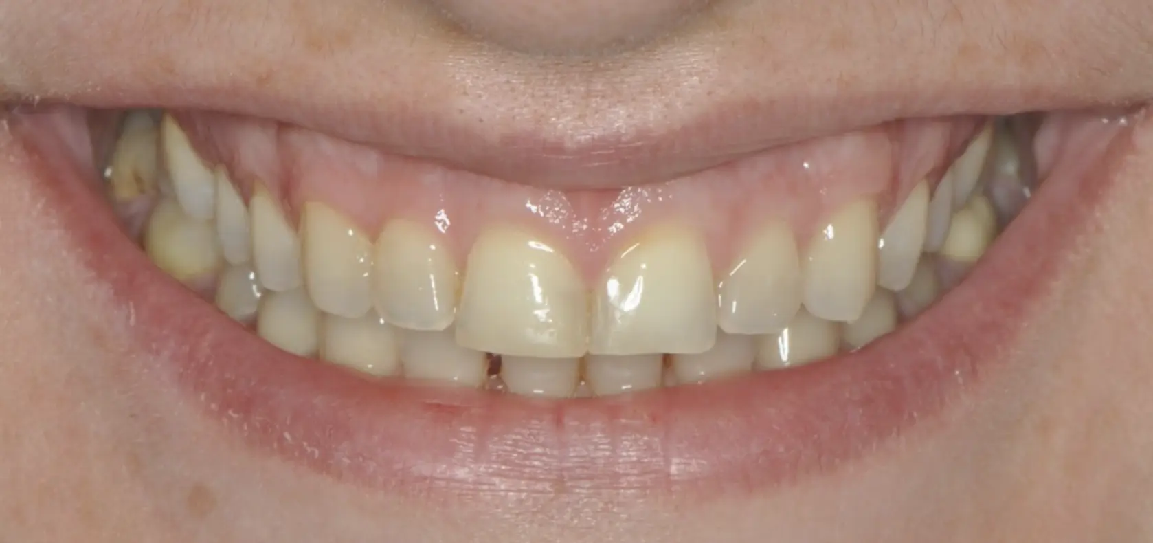 Before and after definitive ceramic restorations (crowns, veneers)