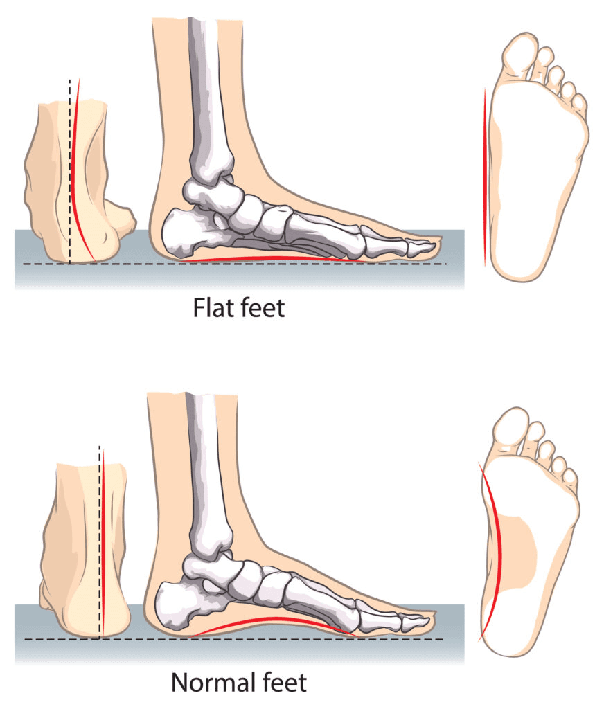 Illustrations of Flat Feet Symptoms & Treatment