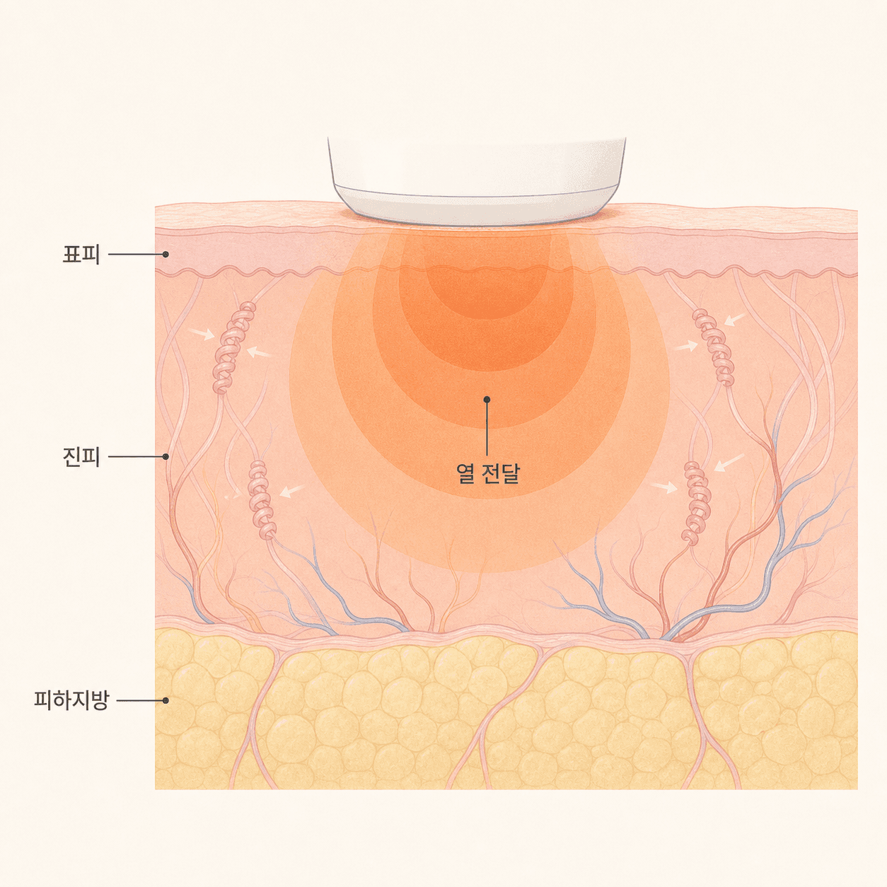 고주파 열이 진피에 넓게 전달되며 콜라겐을 자극해요