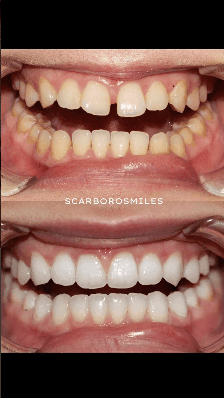 Before and After Invisalign Treatment at ScarboroSmiles Dental Clinic in Scarborough, ON | Best dentist in Scarborough. 