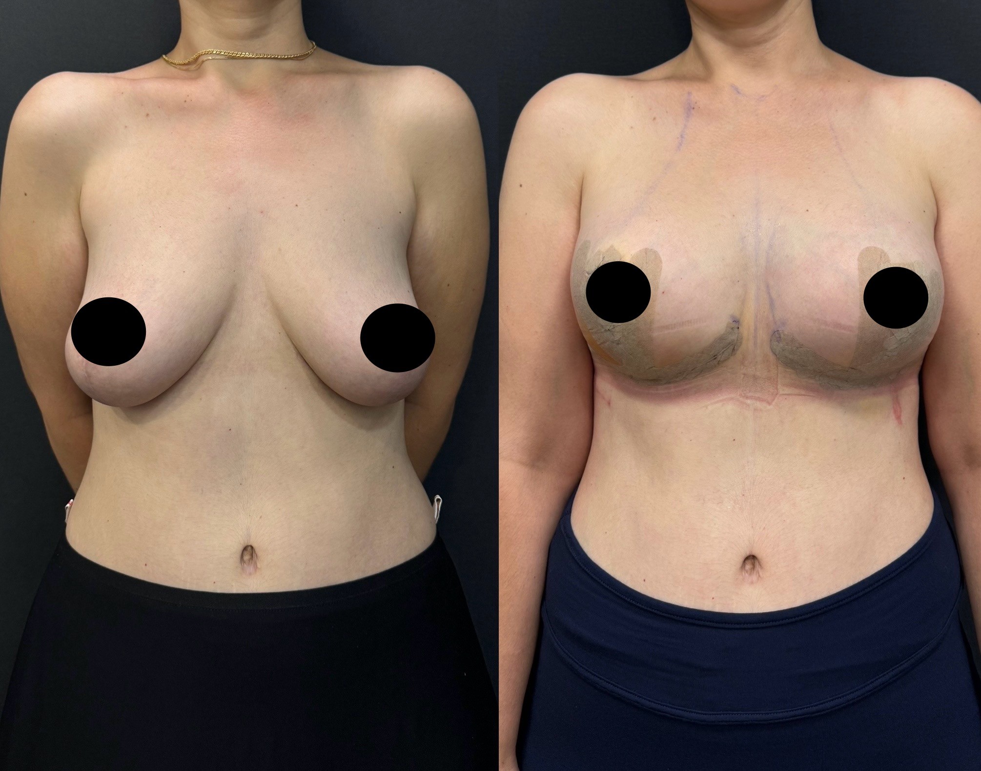 Revision breast lift with implant before after front view