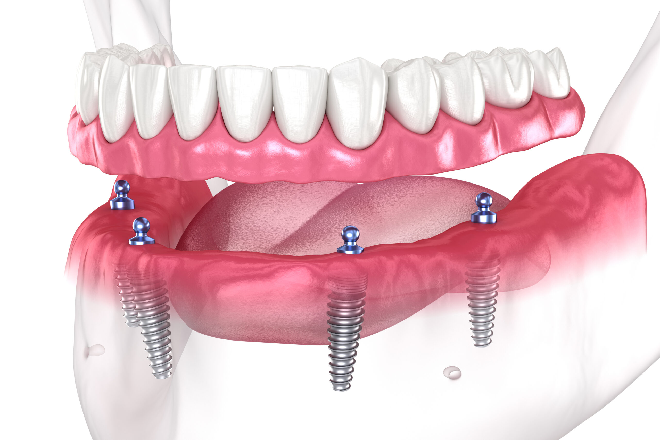 full mouth dental implants