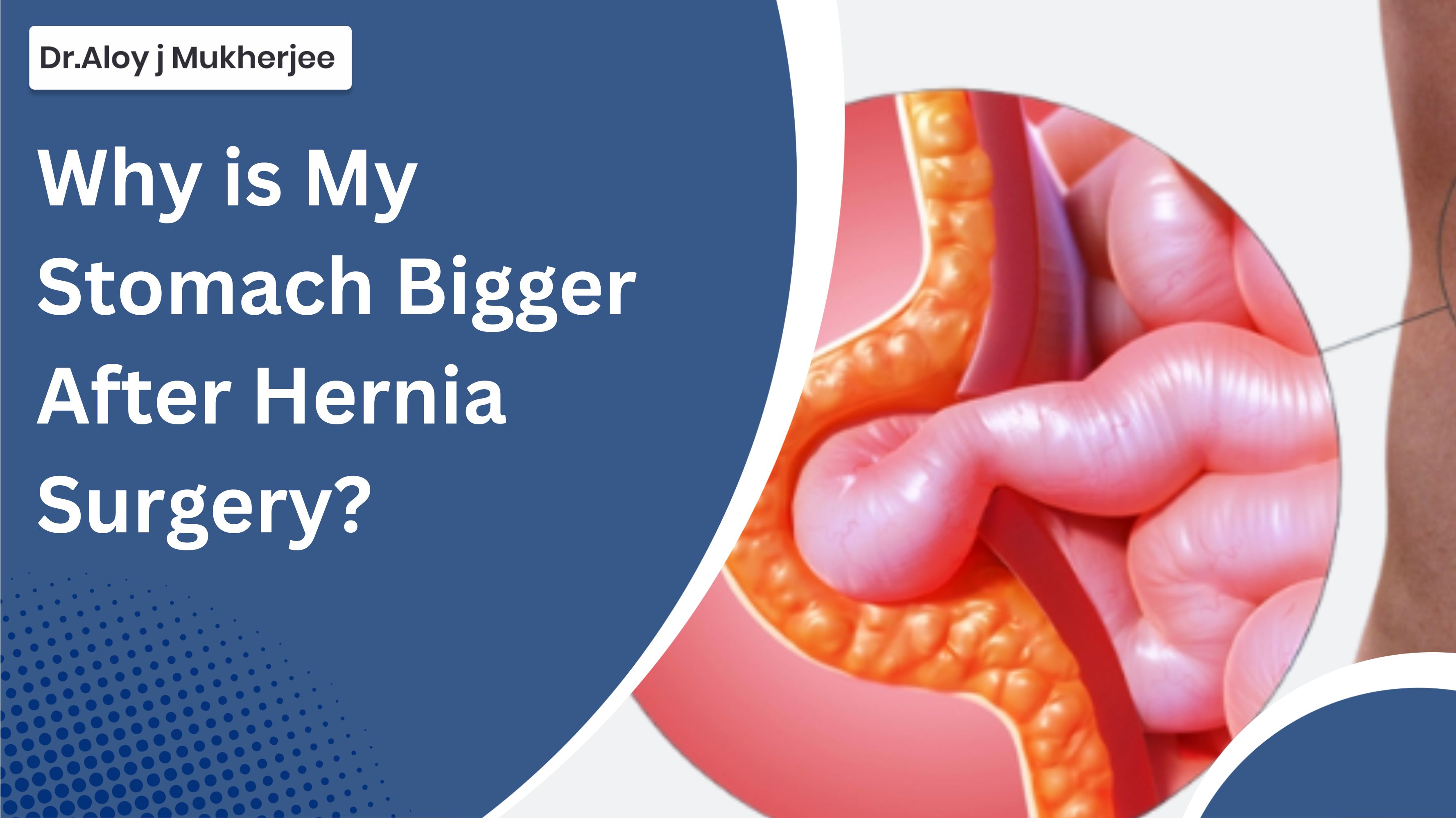 Why is My Stomach Bigger After Hernia Surgery