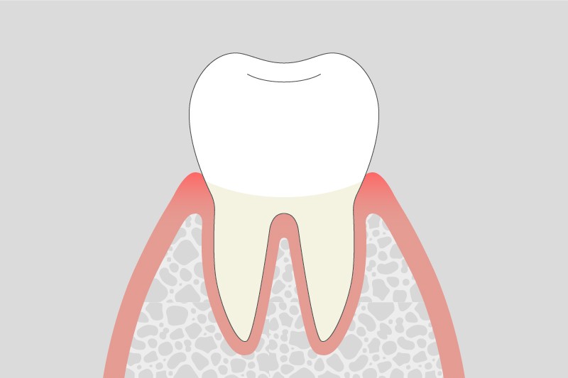 歯周病の症状段階別の特徴