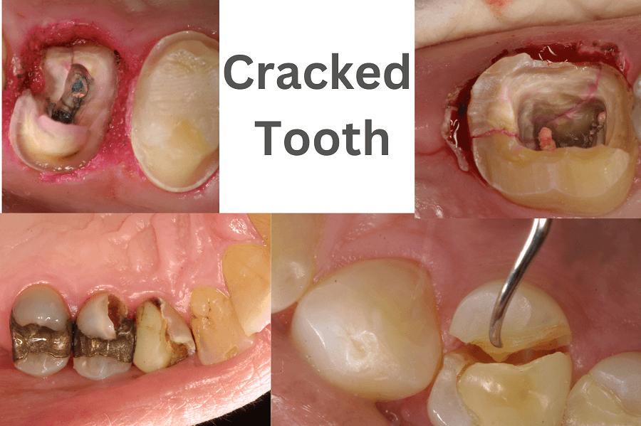 Repair Cracked Teeth Services