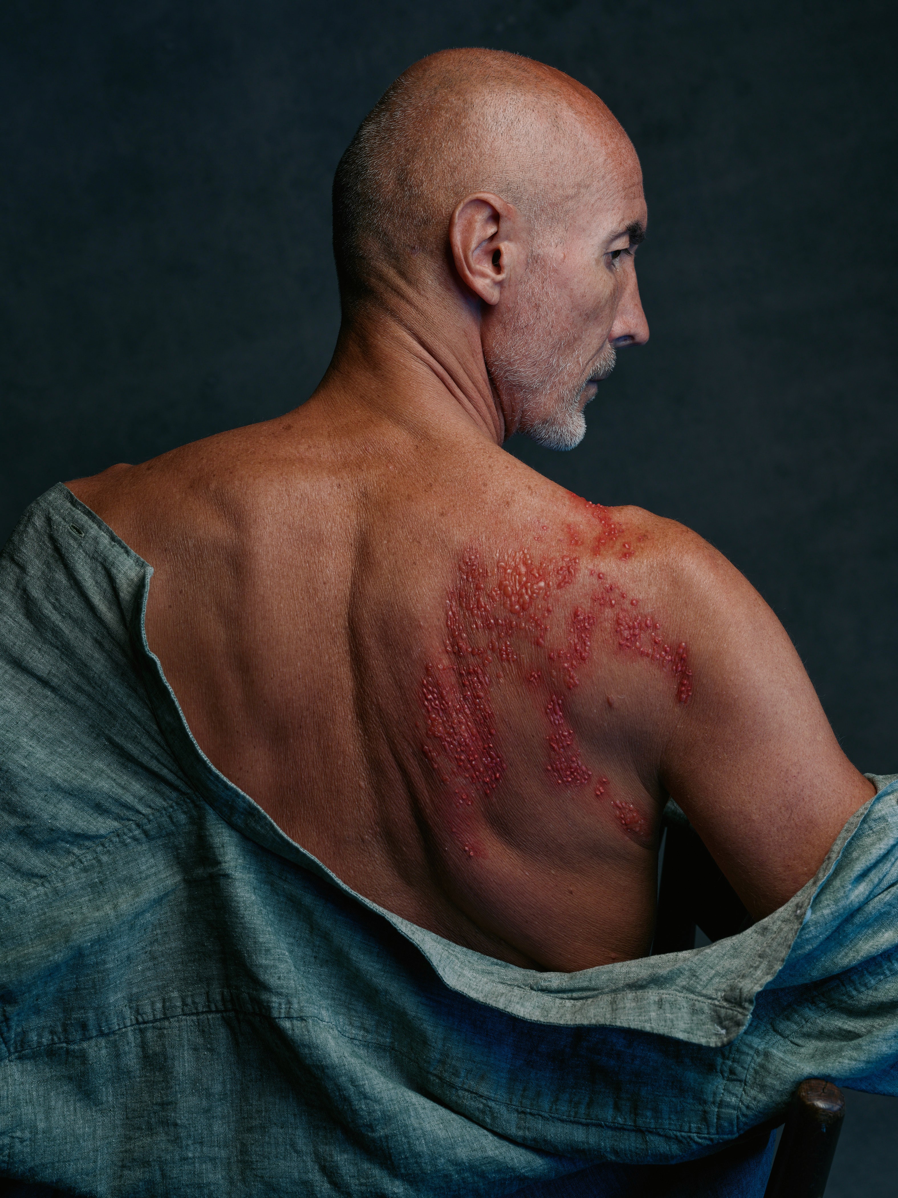 Shingles_man in pain