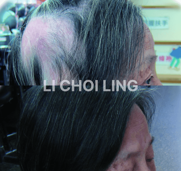 lichoiling casestudy