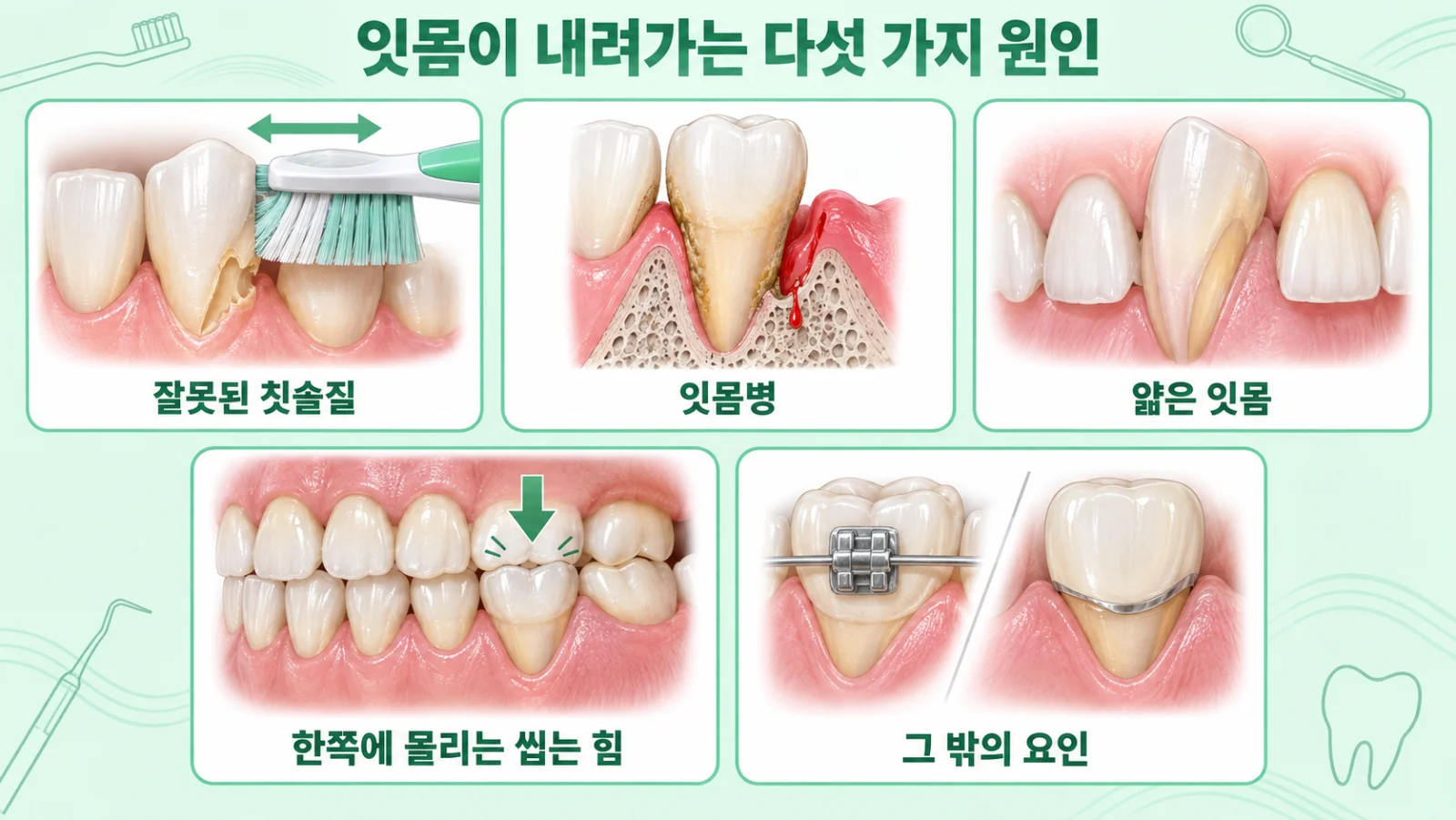 잘못된 칫솔질, 잇몸병, 얇은 잇몸, 한쪽에 몰리는 씹는 힘, 교정·오래된 씌운 치아까지 잇몸이 내려가는 다섯 가지 원인을 그린 일러스트