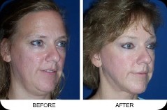 Before and after of surgery image