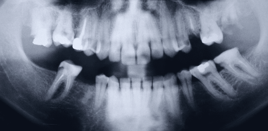 A dental X-ray image showing a panoramic view of a human mouth with visible teeth and jaw, highlighting the dental structure and alignment.