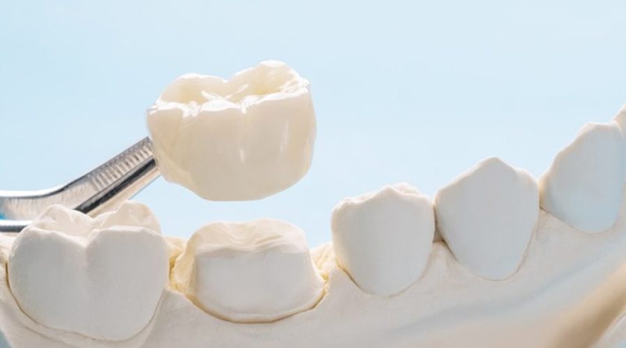 dental crowns