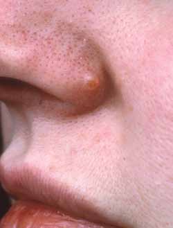 Figure 11: Dermatofibroma