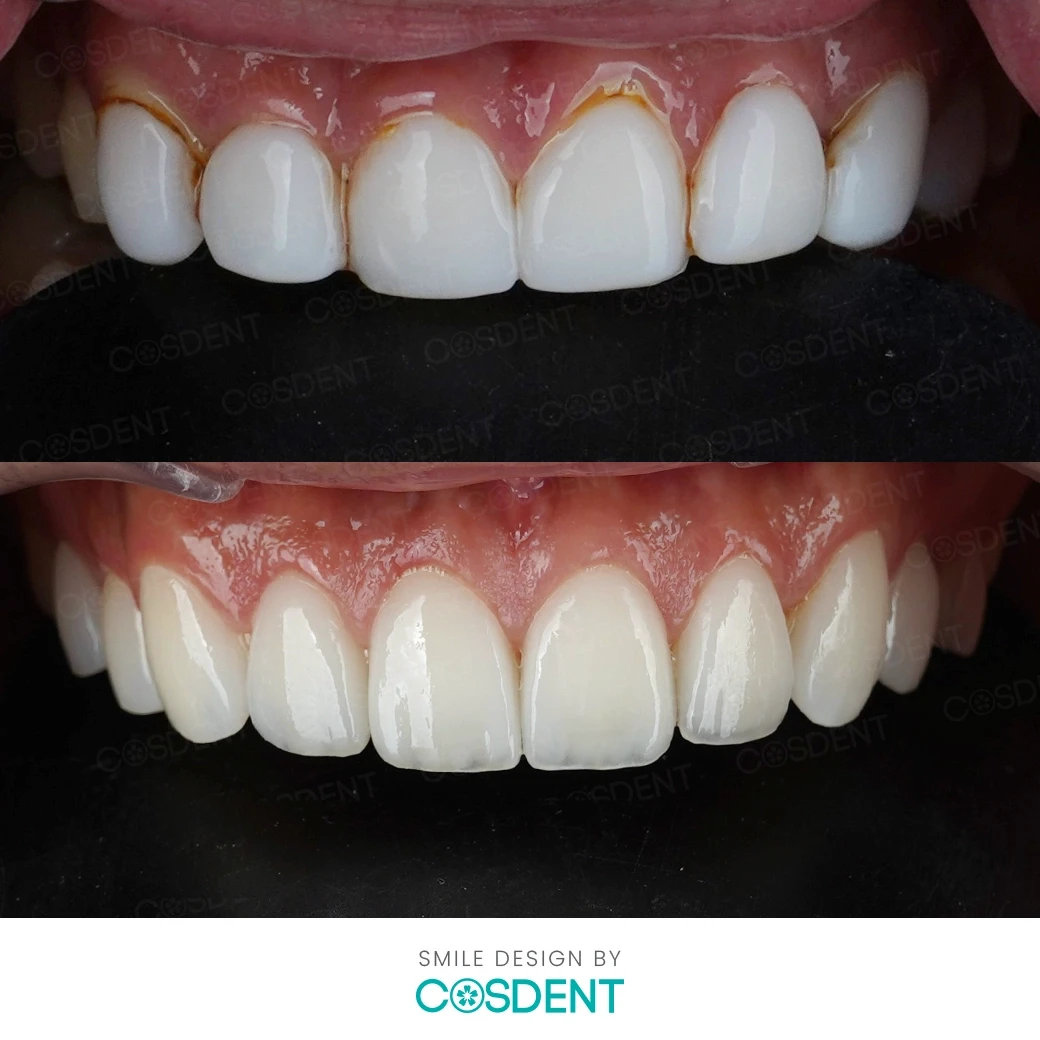 รีวิวออกแบบรอยยิ้ม ที่ cosdent smile design