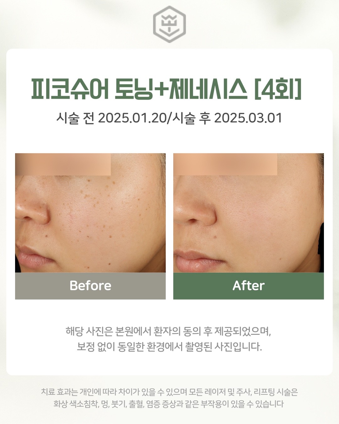 피코슈어 토닝+제네시스 4회