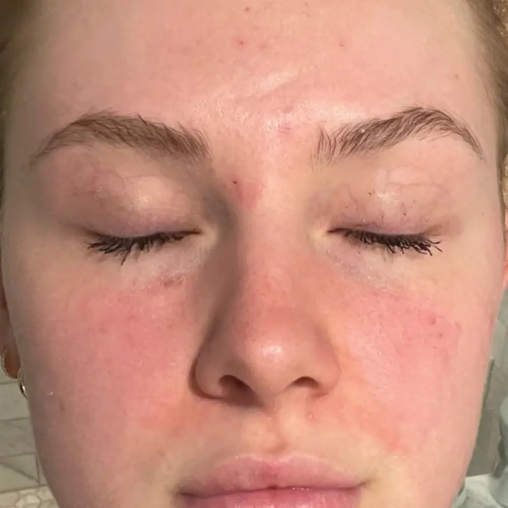 vancouver-aesthetician-hydrators-reactive-skin-damaged-barrier-hydrating-facial-after
