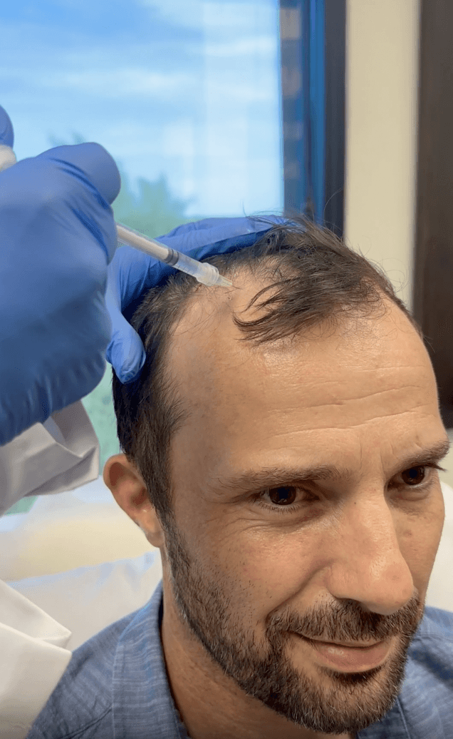 Bio Vantage Cell Therapy Stem Cell Hair Restoration Photo
