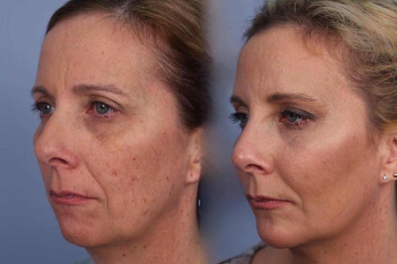 Fractional CO2 Laser | Toronto Plastic Surgeons
