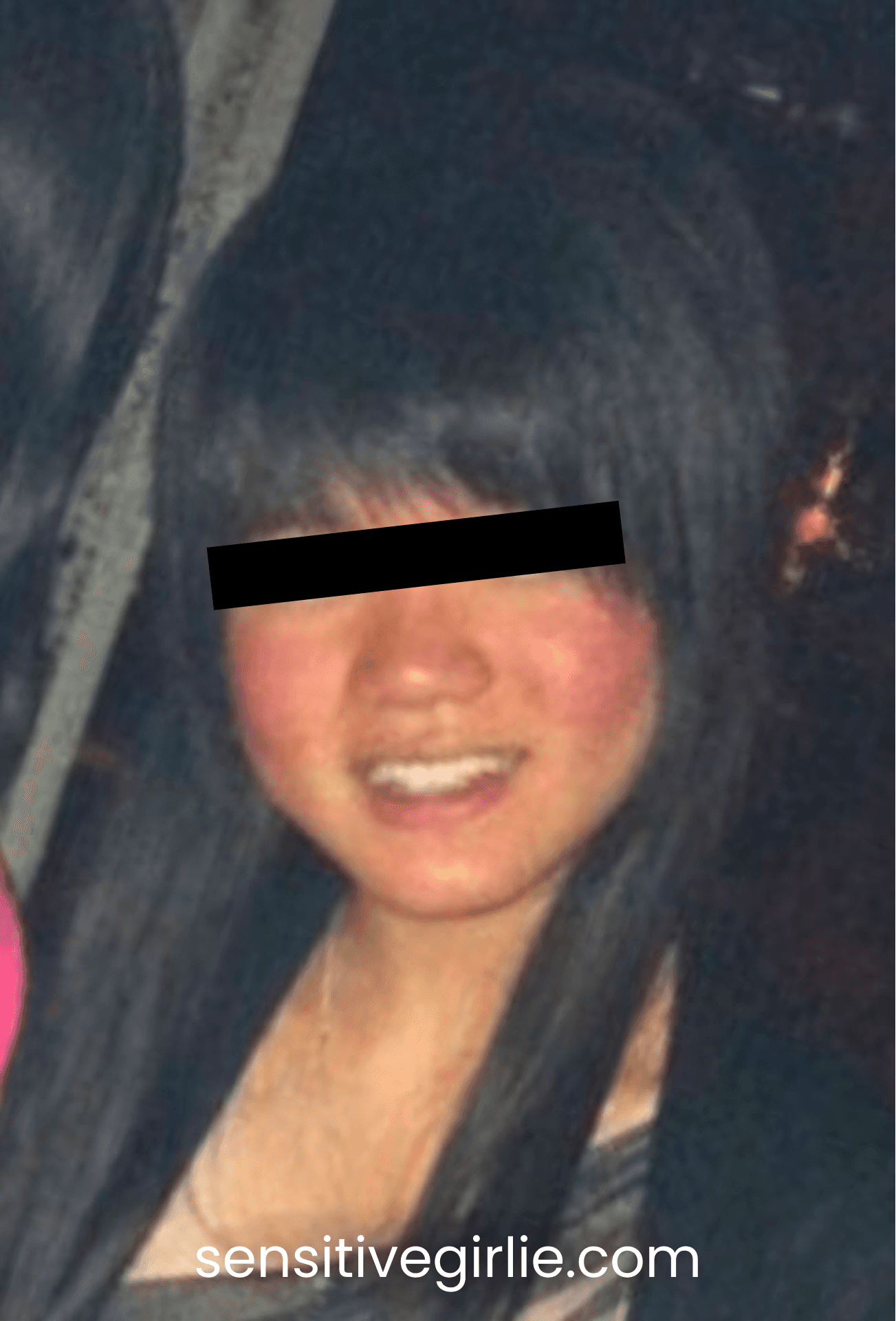 หน้าแพ้สารสเตียรอยด์