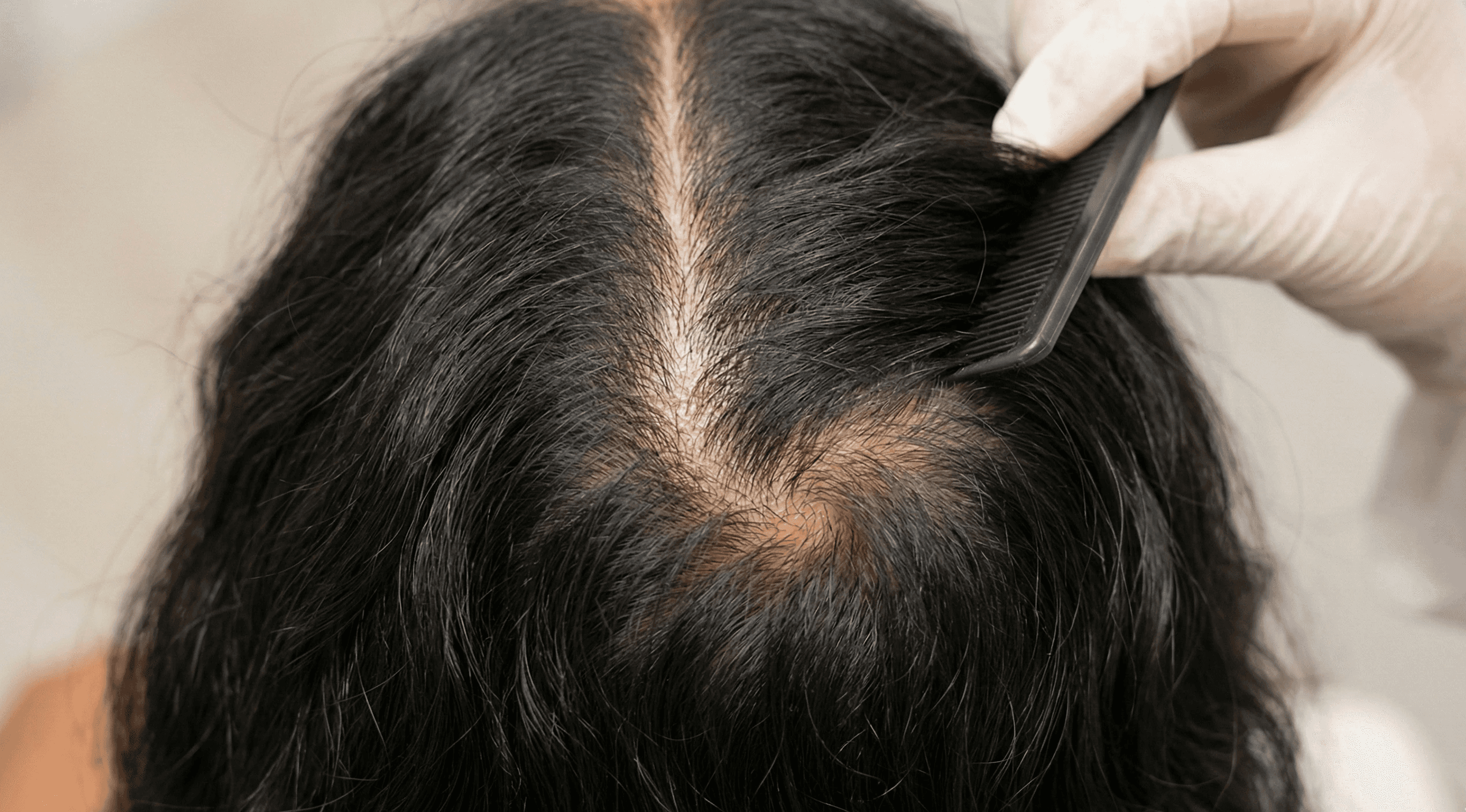 A high-quality clinical close-up of an Indian woman’s scalp showing a widened parting and visible thinning at the crown. The lighting is soft and professional, accurately capturing the dark hair texture and the contrast with the scalp, reflecting common patterns of female or male pattern thinning.