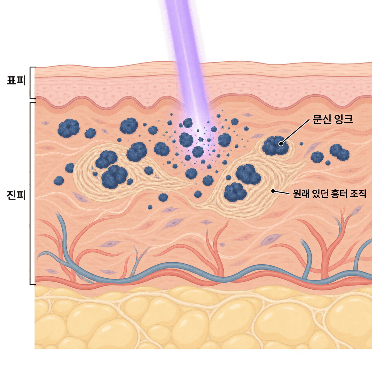 문신을 새길 때 생긴 흉터 조직은 잉크에 가려 있다가 드러나요