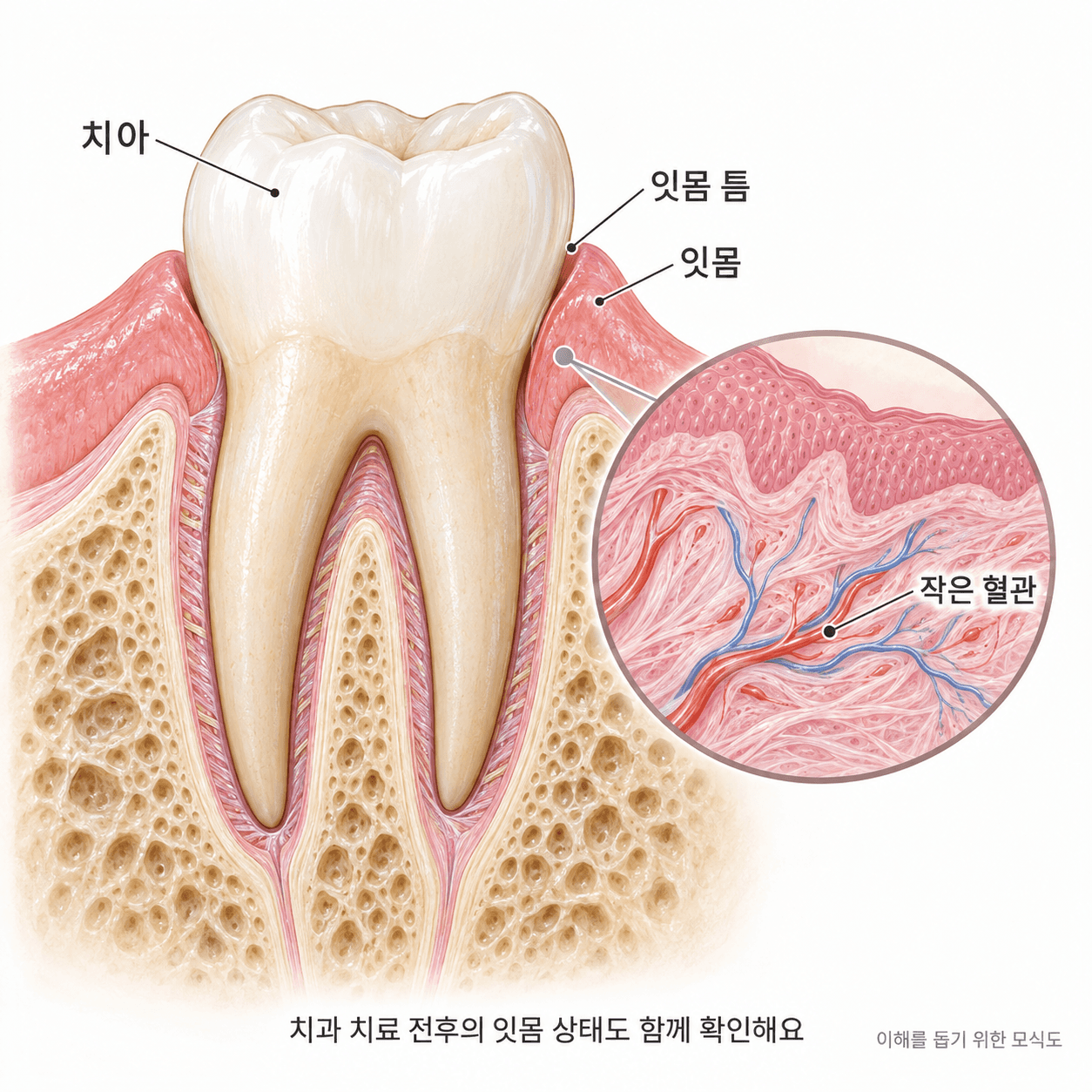 치아 주변 잇몸과 잇몸 조직 내부의 작은 혈관을 확대한 모식도
