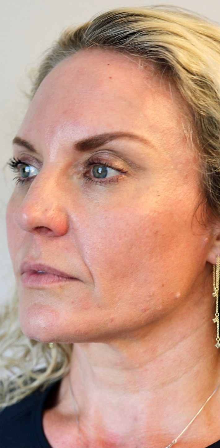 Before: a woman in profile.