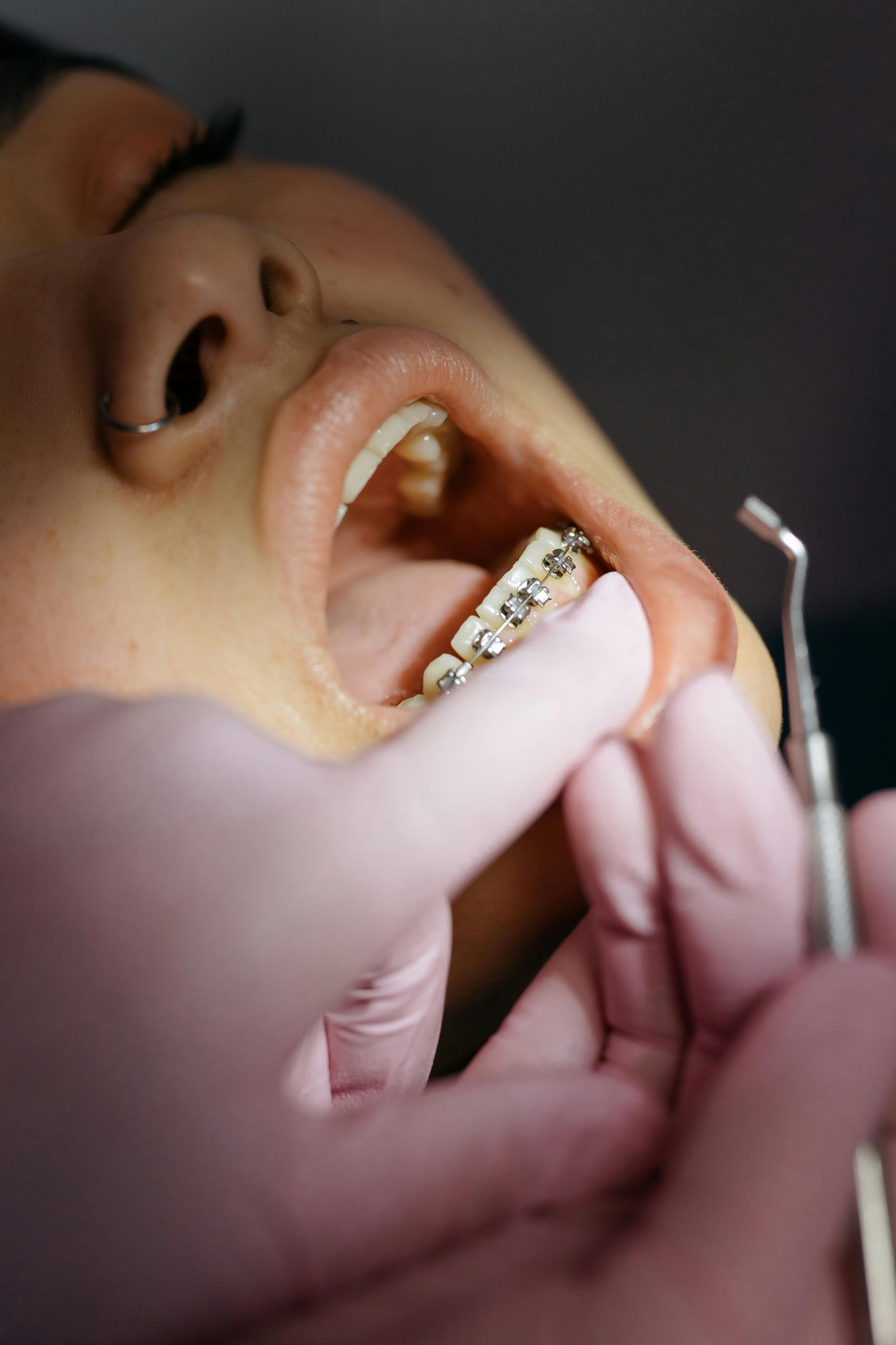braces colac