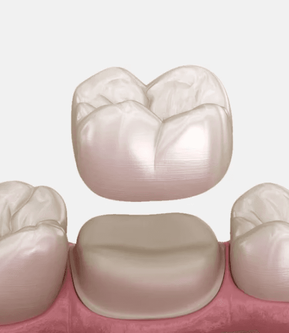 Same-Day Dental Crown Fort Lee