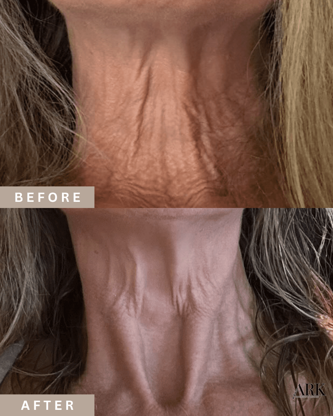 Microneedling before and after result