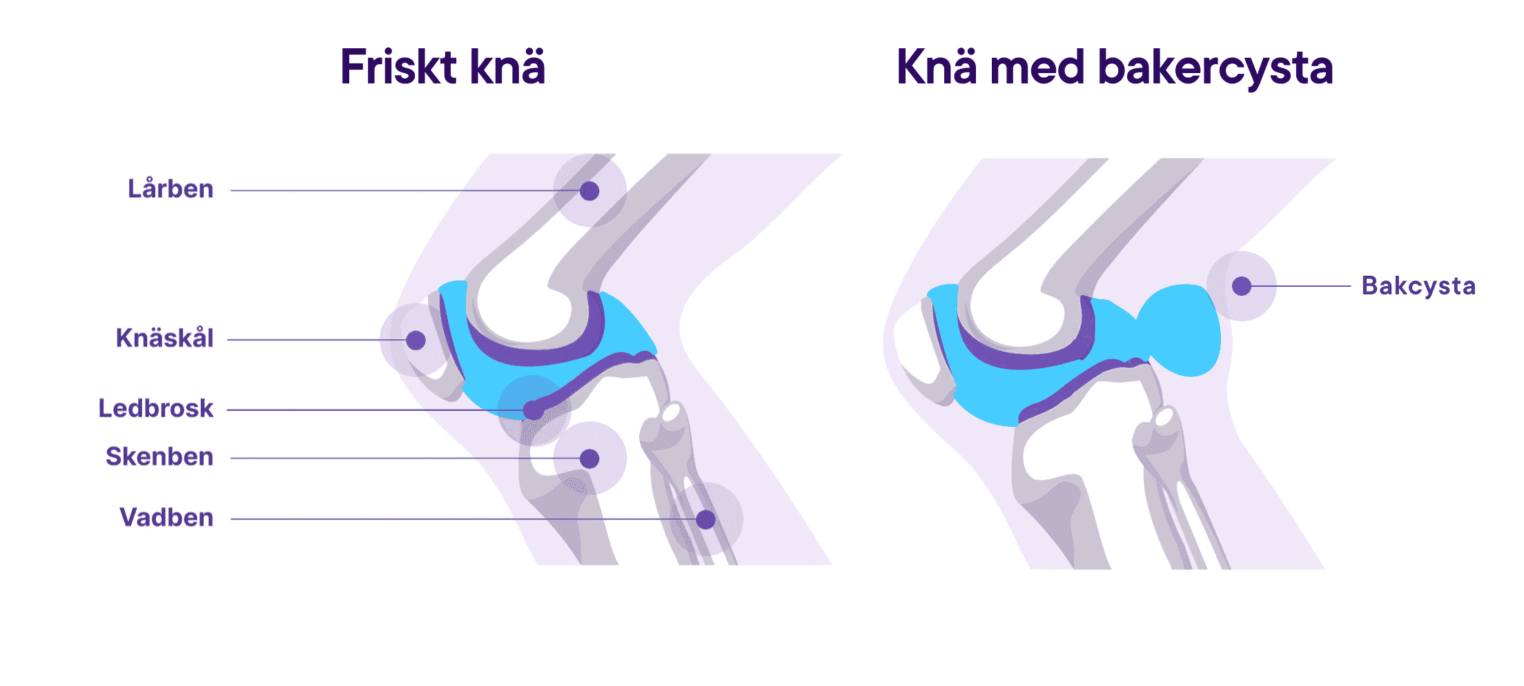 Illustration av ett Knä med bakercysta vs ett friskt knä