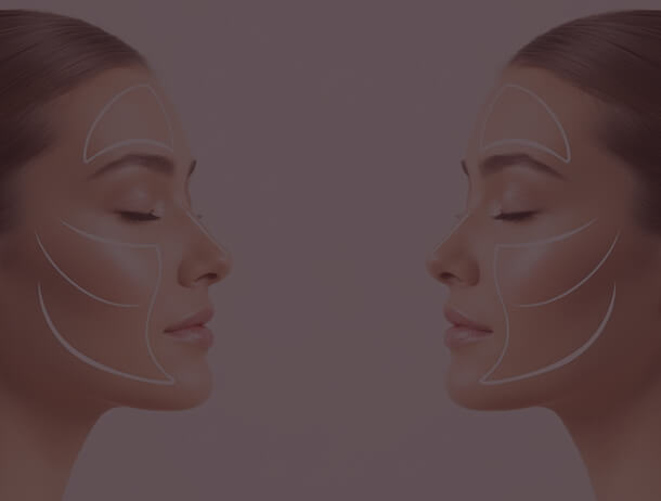 PREENCHIMENTO FACIAL (MALAR, QUEIXO, MANDÍBULA)